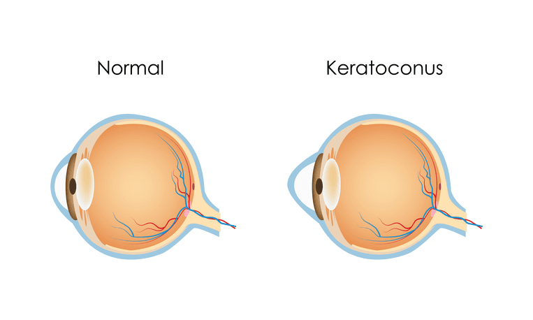 Keratoconus